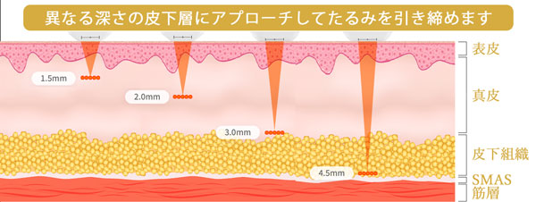 ニューダプロのポイント