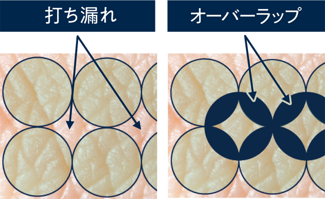 医療脱毛の効果を実感していただける、それが「スプレンダーX」