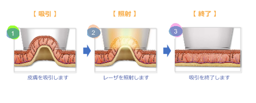 HSハンドピース（吸引アシスト）